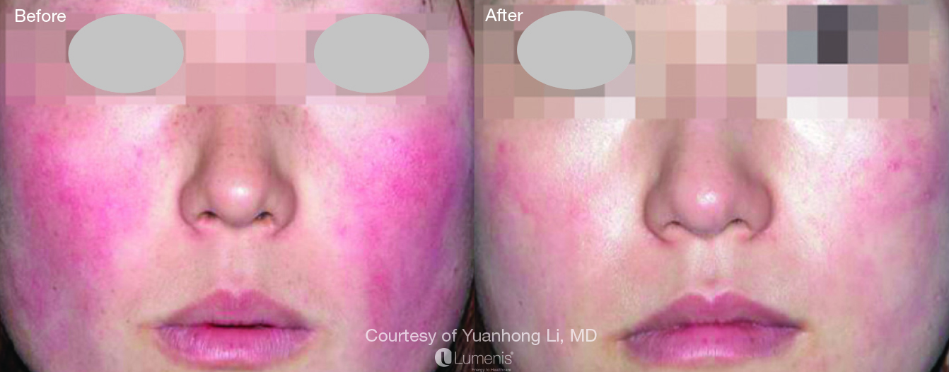 Rosacea Before and After