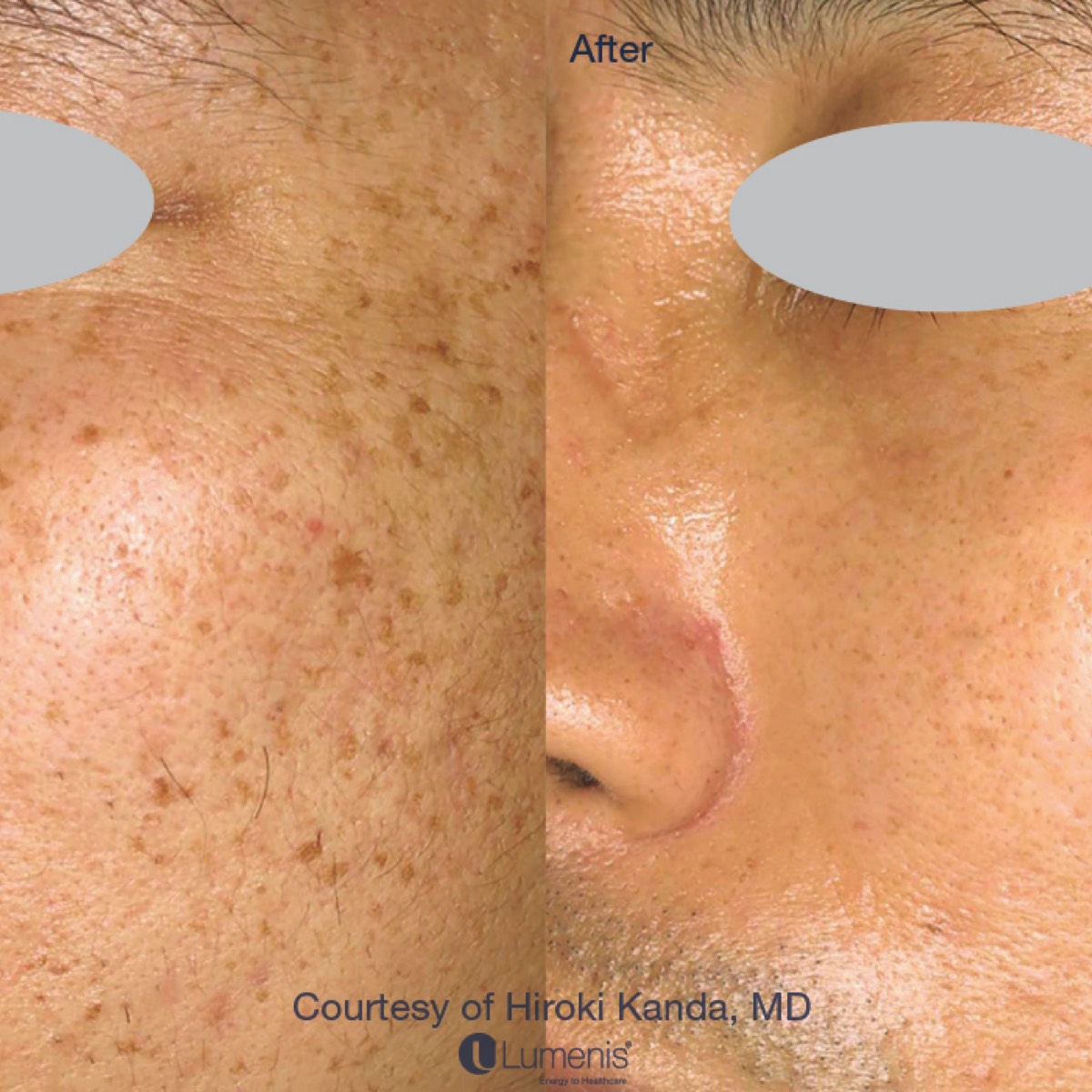 IPL treated brown spots on face of asian man before and after photo.