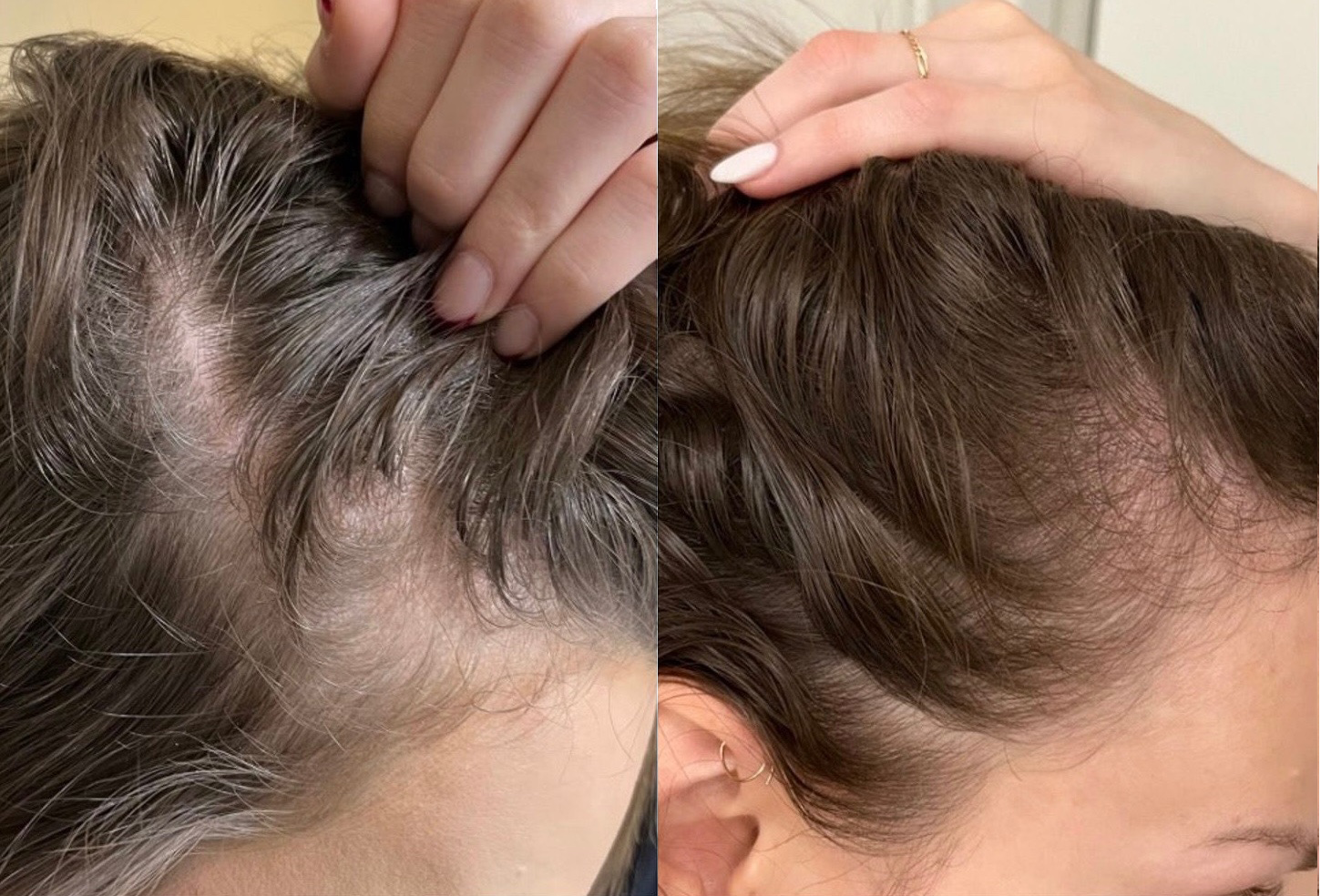 Before and After Results - Woman before and after hairline top of head from hair restoration