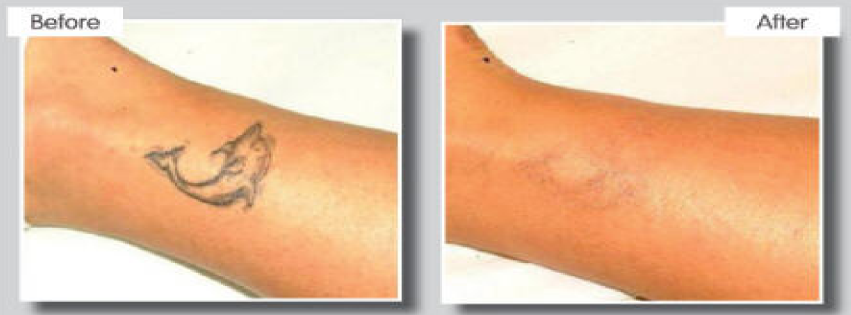 dolphin before and after