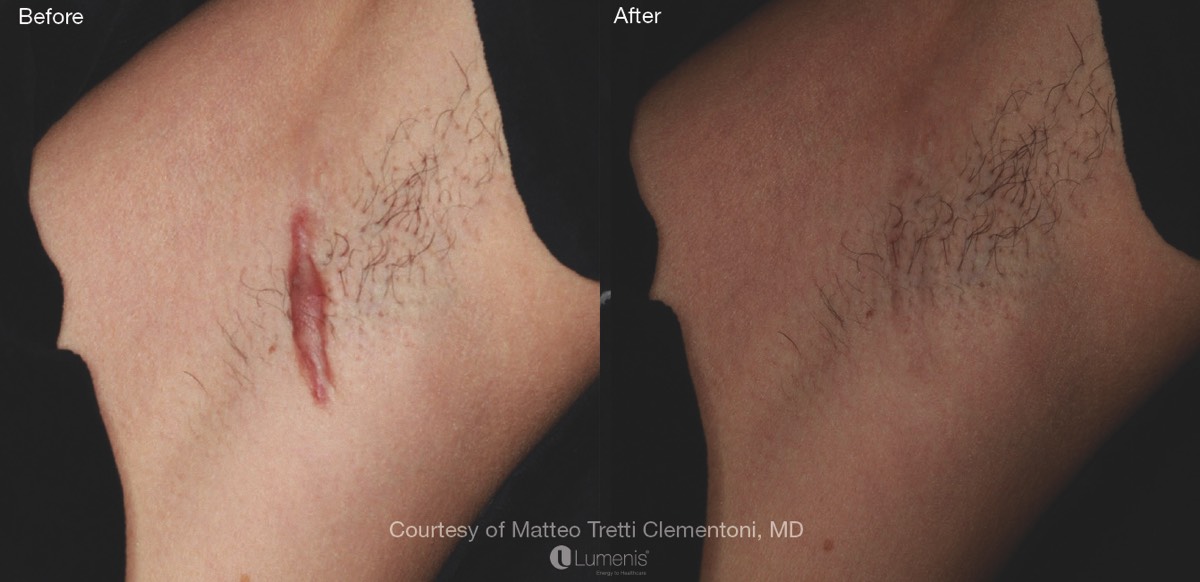 scarring before and after treatment with ResurFx fractional laser