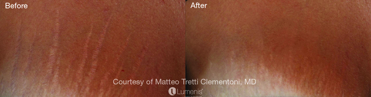 Before and after images of stretchmarks or striae distensae.