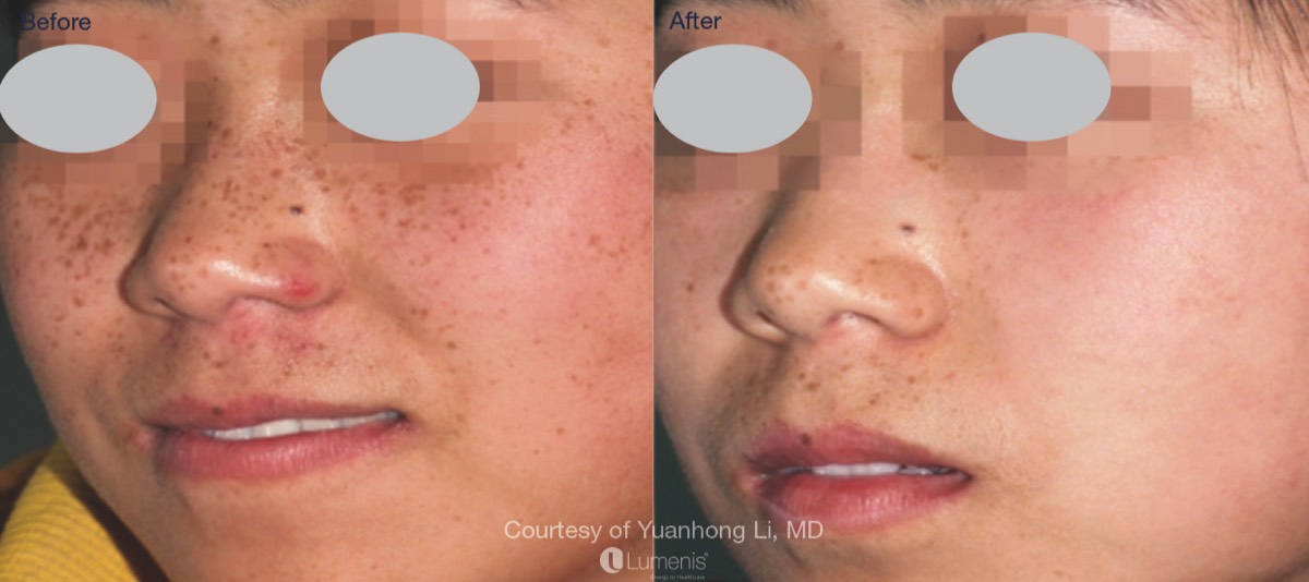 Freckle reduction from IPL before and after photo.
