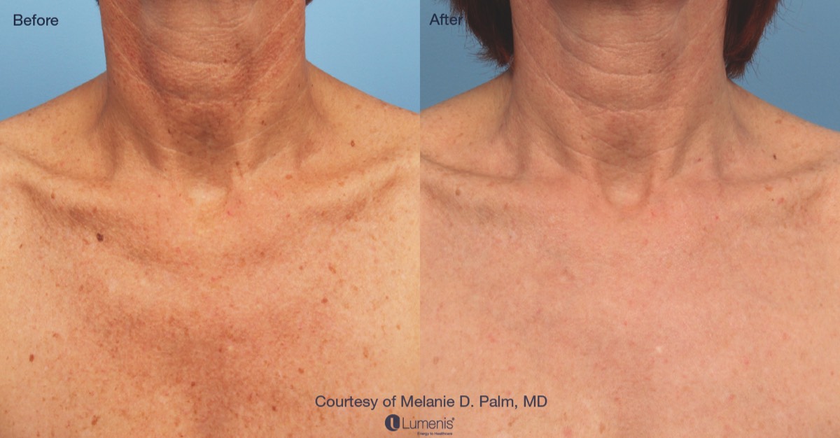 Before and after image of chest where IPL treats brown spots.