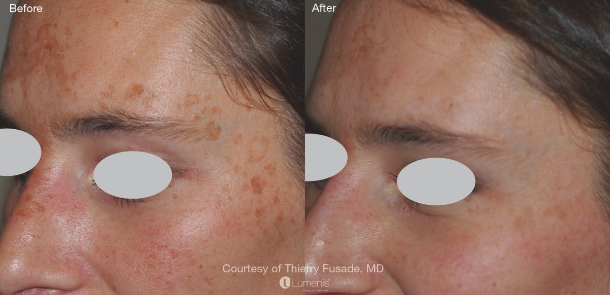 split-screen image of face showing sun damage before and after IPL treatment
