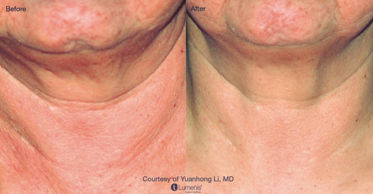 Before and after image showing effects of IPL and fractional laser.