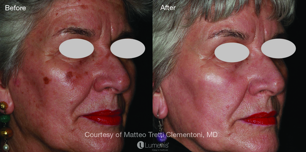 IPL treated brown spots on face of older woman before and after photo.
